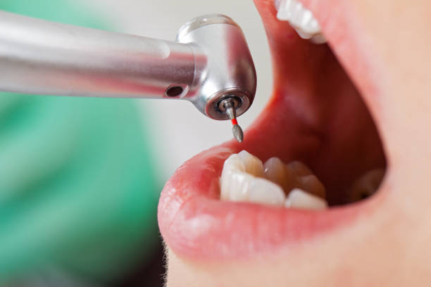 Best Emergency Tooth Extraction in Bass Lake, IN